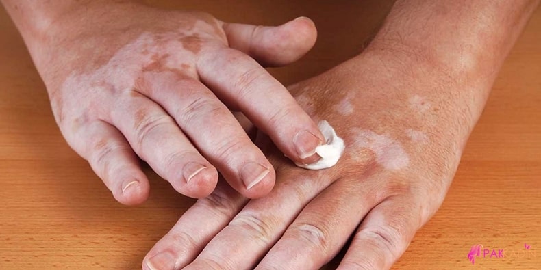 Vitiligo Hastalığı Tedavisi