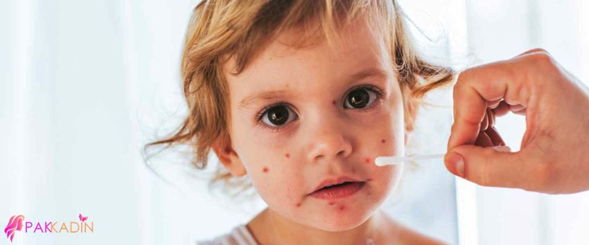 Suçiçeği Aşısı Çocuklarda