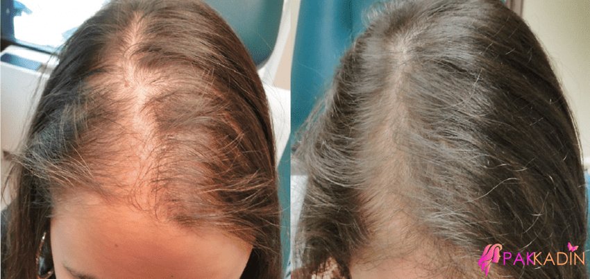 Kadınlarda Saç Dökülmesi Tedavisi