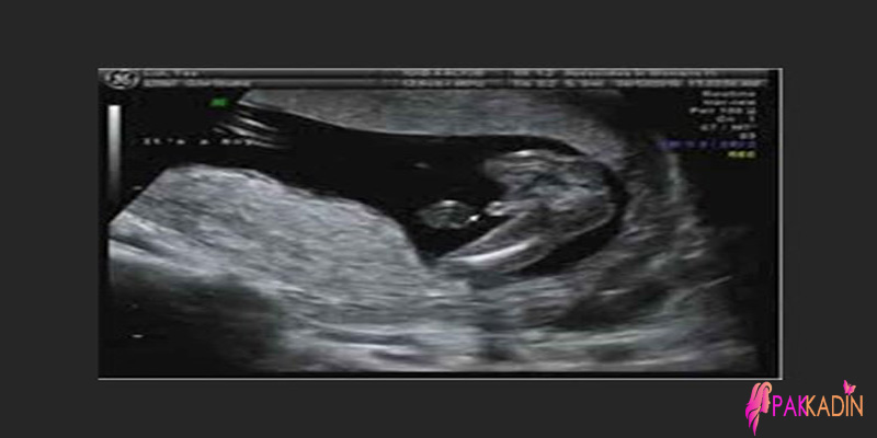 15 Hafta Gebelik Ultrason Görüntüleri