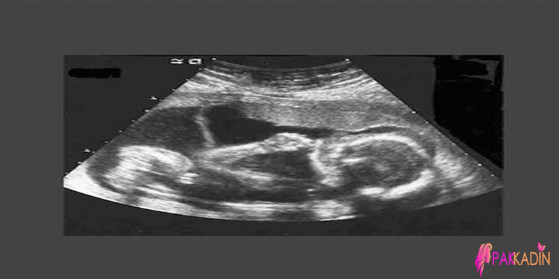 17 Hafta Gebelik Ultrason Görüntüleri