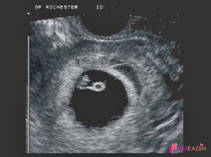 1.Hafta Hamilelikte Ultrason Görüntüleri