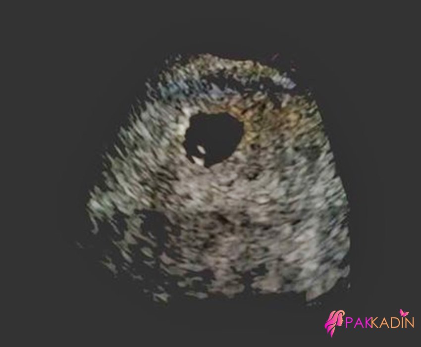 2 Hafta Hamilelikte Ultrason Görüntüleri