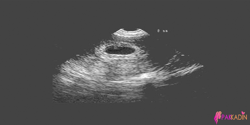 3. Hafta Gebelik Ultrason Görüntüleri