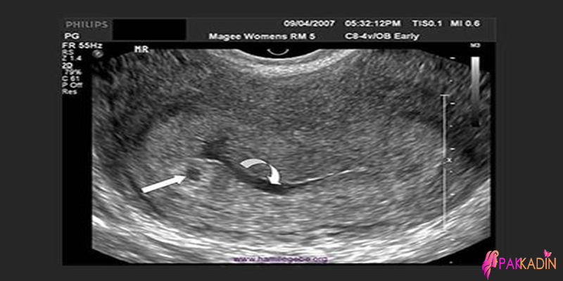 4. Hafta Gebelik Ultrason Görüntüleri