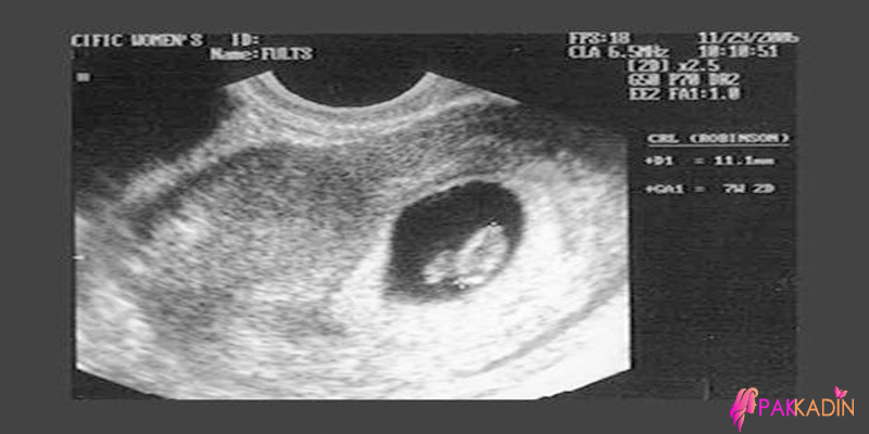 5. Hafta Gebelik Ultrason Görüntüleri