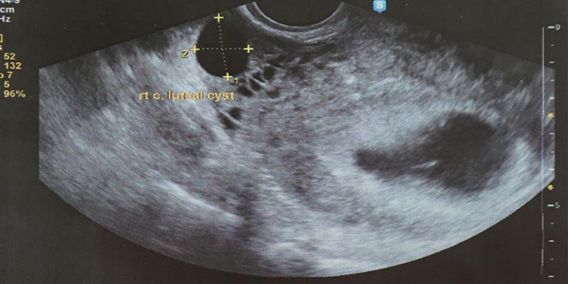 5. Hafta Gebeliğin Ultrason Görüntüleri