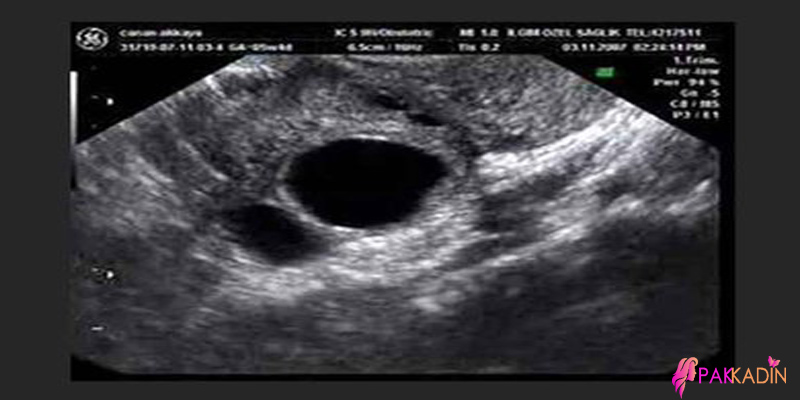6. Hafta Gebelikte Ultrason Görüntüleri