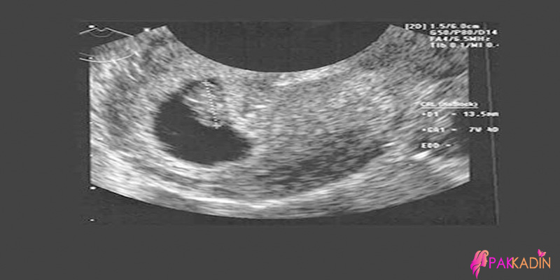 7.Hafta Gebelik Ultrason Görüntüleri
