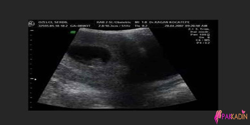 8. Hafta Ultrason Görüntüleri
