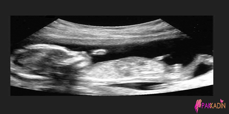 14. Hafta Gebelik Ultrason Görüntüleri